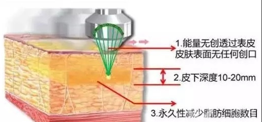做超聲波吸脂手術(shù)的時(shí)候疼嗎？