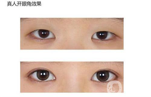做開(kāi)眼角手術(shù)需要多少錢(qián)？