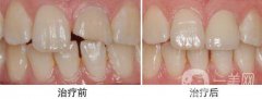 裝個(gè)烤瓷牙多少錢？烤瓷牙詳細(xì)價(jià)格介紹