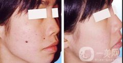 激光點(diǎn)痣大概多少錢？激光祛痣的價(jià)格詳解