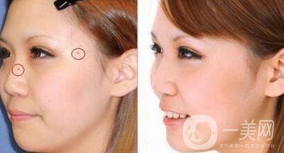 激光點(diǎn)痣大概多少錢？激光祛痣的價(jià)格詳解