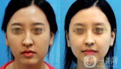 歪鼻矯正需要多少錢(qián)？上海歪鼻矯正價(jià)格詳解