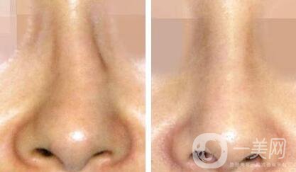 歪鼻矯正需要多少錢？上海歪鼻矯正價格詳解
