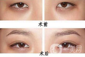 韓式開眼角哪*果好？哪個醫(yī)院做韓式開眼角比較好