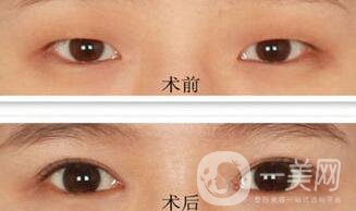 韓式開眼角哪*果好？哪個醫(yī)院做韓式開眼角比較好
