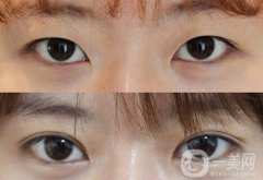 做高分子雙眼皮多少錢？高分子雙眼皮價(jià)格介紹