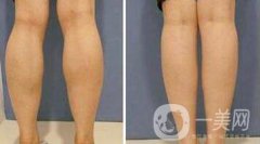 注射瘦臉要多少錢？注射注射瘦臉價(jià)格詳細(xì)介紹