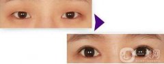 開(kāi)眼角的果到底怎么樣？開(kāi)眼角前后圖
