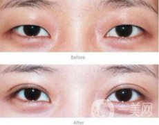 焊接雙眼皮果怎么樣？焊接雙眼皮有什么缺點(diǎn)