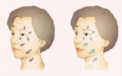 小切口拉皮除皺術果一般能維持幾年？