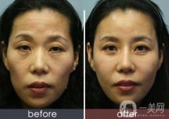 自體脂肪臉部填充果可以維持多久？