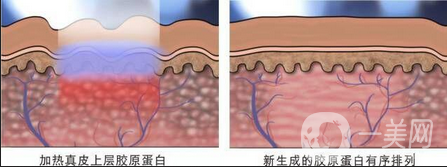 做像素激光調(diào)節(jié)痘疤一般多少錢？