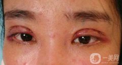 做完韓式三點雙眼皮之后眼睛會腫嗎？