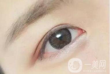 做完韓式三點(diǎn)雙眼皮之后眼睛會(huì)腫嗎？