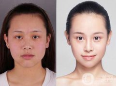 改臉型手術一般多少錢 價格詳情