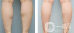 注射瘦腿*果嗎、注射瘦腿有副作用嗎