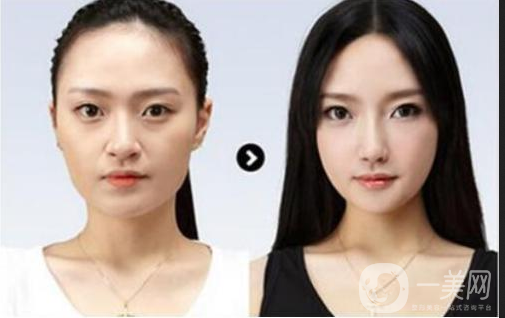 做完墊鼻梁硅膠*果能堅持幾年？