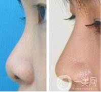 耳軟骨墊鼻尖手術(shù)做完需要多久恢復(fù)正常？
