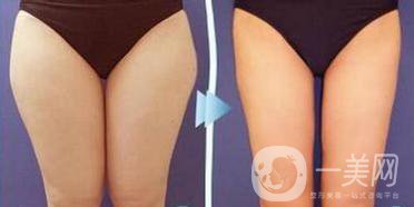 溶脂減肥手術(shù)的價(jià)格一般多少錢？