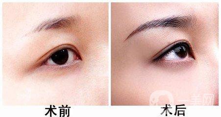 廣東玻尿酸豐眉弓手術(shù)費(fèi)用 價格詳情一覽