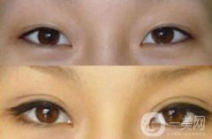 上海九院割雙眼皮多少錢 上海九院做雙眼皮價(jià)格詳解