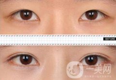 成都哪里割雙眼皮好 哪家醫(yī)院雙眼皮做的好