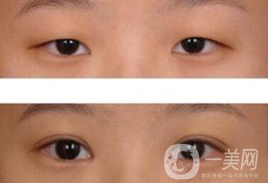 威海割雙眼皮多少錢？雙眼皮手術價格詳解