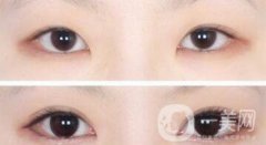韓式*開眼角多少錢  韓式*開眼角恢復(fù)圖