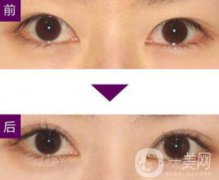 三點(diǎn)定位雙眼皮手術(shù)有副作用嗎、果怎么樣