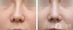 矯正鼻子大概多少錢？矯正鼻子多少費(fèi)用詳情