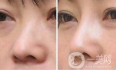 上海縮小鼻頭手術(shù)多少錢 縮小鼻頭整形價(jià)格介紹