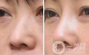 上?？s小鼻頭手術(shù)多少錢 縮小鼻頭整形價格介紹