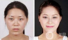 注射隆鼻一般多少錢？廣東隆鼻注射價(jià)格介紹