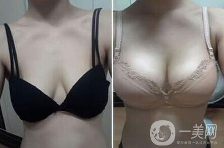 娜高假體隆胸多少錢 上海娜高假體隆胸價格詳解