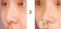 杭州駝峰鼻矯正多少錢 駝峰鼻手術價格