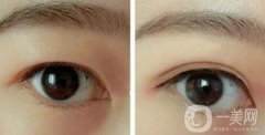 韓式三點(diǎn)雙眼皮的缺點(diǎn)詳細(xì)介紹 手術(shù)前后圖