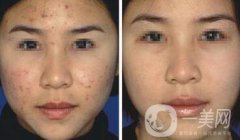 像素激光去痘多久才會(huì)好 祛痘對果