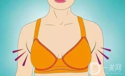 副乳吸脂,多久消腫