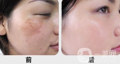 黃褐斑怎么形成的 怎么去除？