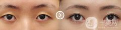杭州哪里割雙眼皮好 杭州哪家雙眼皮醫(yī)院好