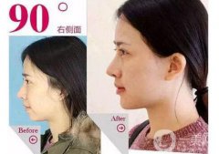 鼻子矯正費(fèi)用 歪鼻矯正多少錢