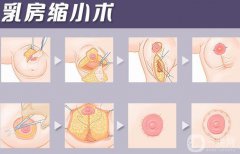 巨乳縮小疤痕嚴(yán)重怎么辦 巨乳縮小后祛疤方法