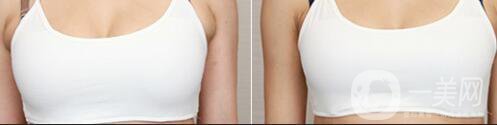 上海副乳切割手術(shù)多少錢 副乳切除手術(shù)價(jià)格詳解