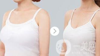 乳房縮小手術(shù)*嗎 乳房縮小有風(fēng)險嗎