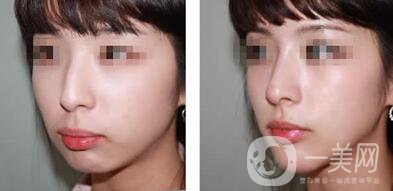 鷹鉤鼻矯正注意事項詳細(xì)介紹 鷹鉤鼻矯正如何護(hù)理