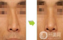 深圳歪鼻矯正一般多少錢 歪鼻矯正的價(jià)格詳解