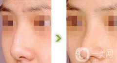 駝峰鼻矯正價錢 駝峰鼻矯正手術(shù)具體費用