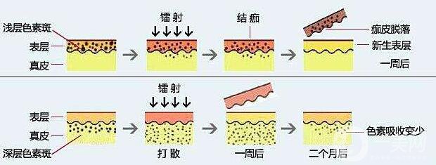 老年斑怎么調(diào)節(jié) 激光去老年斑怎么樣