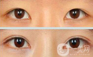 割雙眼皮疼不疼？打了麻藥還疼嗎？