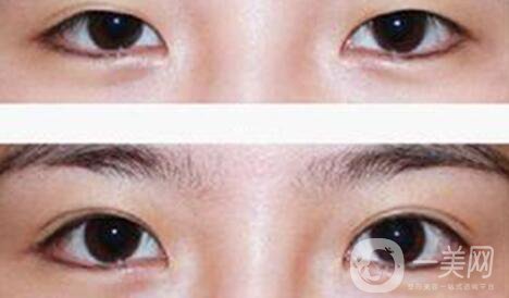 割雙眼皮疼不疼？打了麻藥還疼嗎？